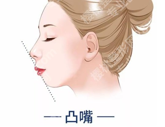 南方医科大学南方医院正颌手术如何？价格及案例分享！