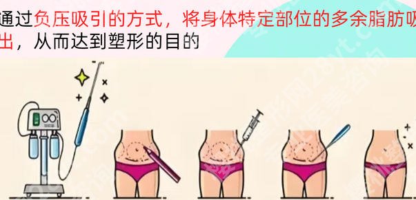 惠州中心医院抽脂怎么样？腰腹/大腿/手臂吸脂等技术一文看懂