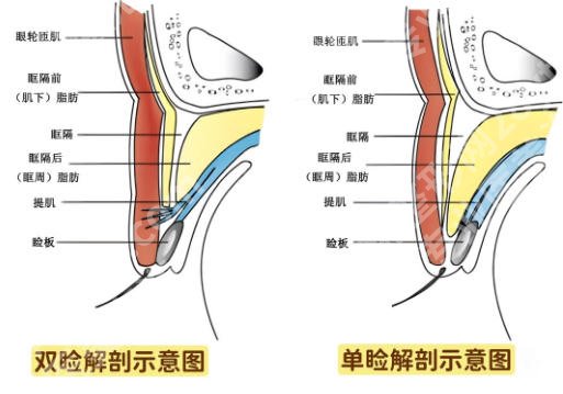 中山大学附属第三医院双眼皮手术怎么样？2026内行人实测价目表！