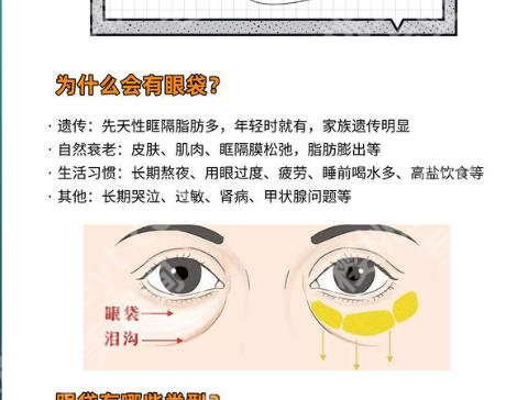 上海东方医院去眼袋挂什么科？眼袋类型、适合的手术方式一篇说清！