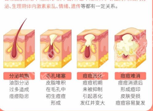广州南方医院激光祛痘多少钱？祛痘案例反馈、超全资料！