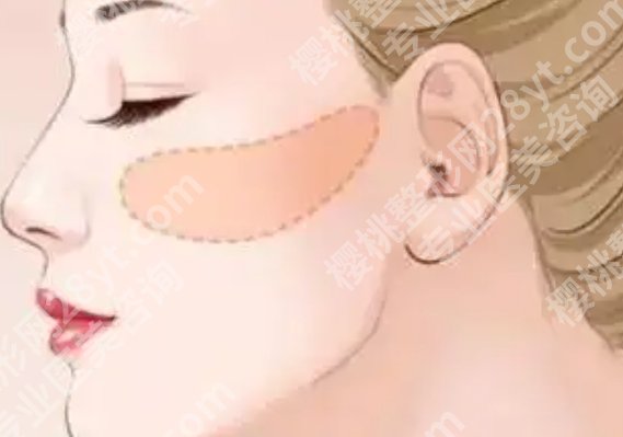 上海东方医院磨骨手术费用|下颌30673—67058元左右！