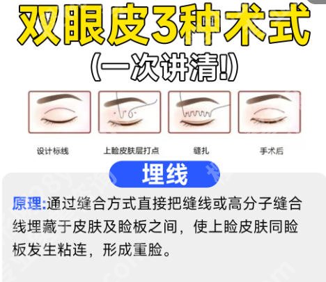 上海中山医院双眼皮价格揭示！感兴趣的快来看！