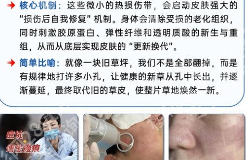北京医院点阵激光价格对比详细来袭！费用信息、避坑指南公布