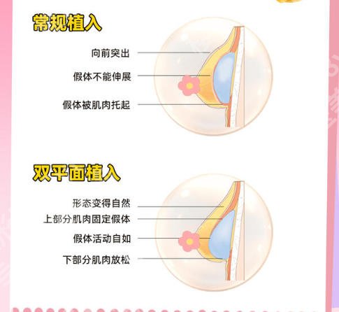 上海第一人民医院假体隆胸多少钱？2026真实费用与避坑指南速看