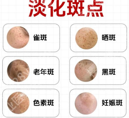 重庆附一院祛斑好不好？2026祛斑案例鉴赏！含价格