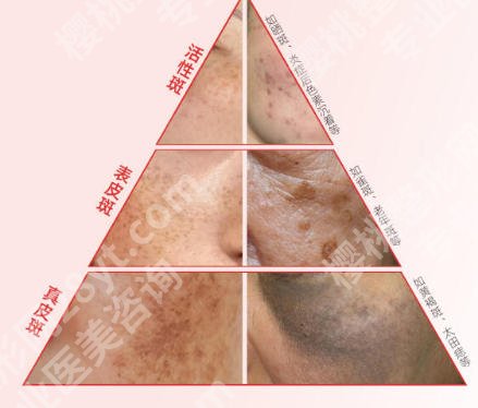 重庆附一院祛斑好不好？2026祛斑案例鉴赏！含价格