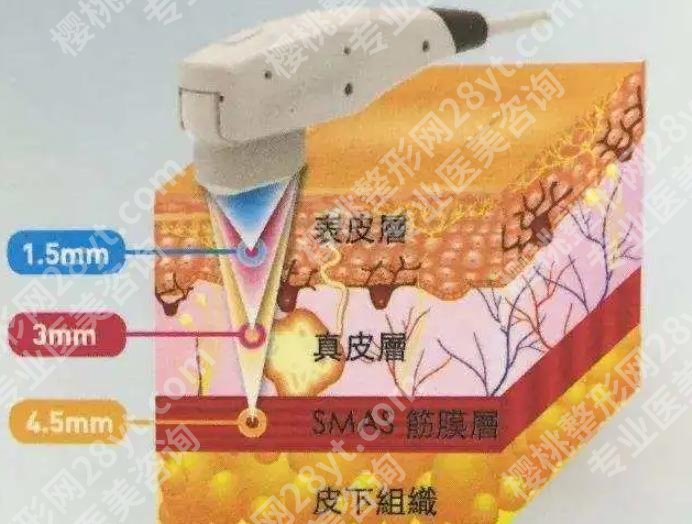 台州医院除皱多少钱？除皱方式不同费用有所区别！