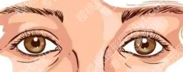 北医三院双眼皮手术要多少钱？价格大概是6600~10,500元左右！