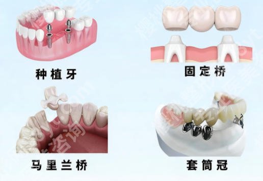 余姚二院种牙怎么样？附种植体品牌对比！