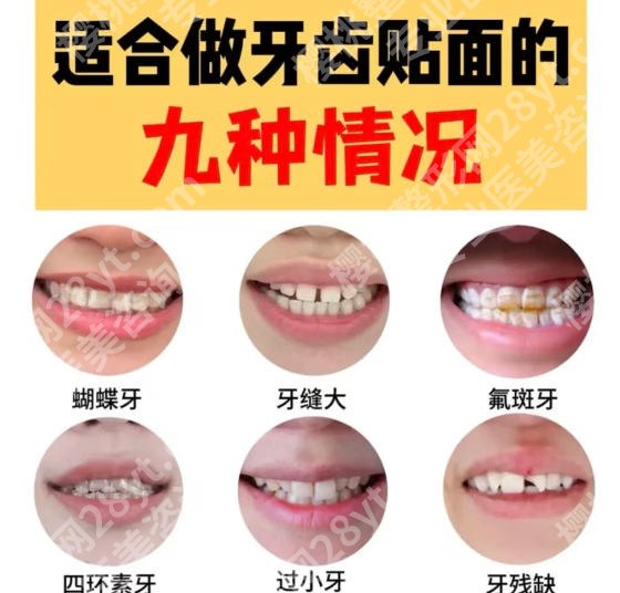 北京大学深圳医院牙齿贴面技术如何？2026收费细节展示！点击预览