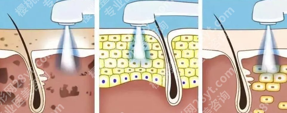 上海六院点阵激光手术技术如何？嫩肤手术案例流程分享！