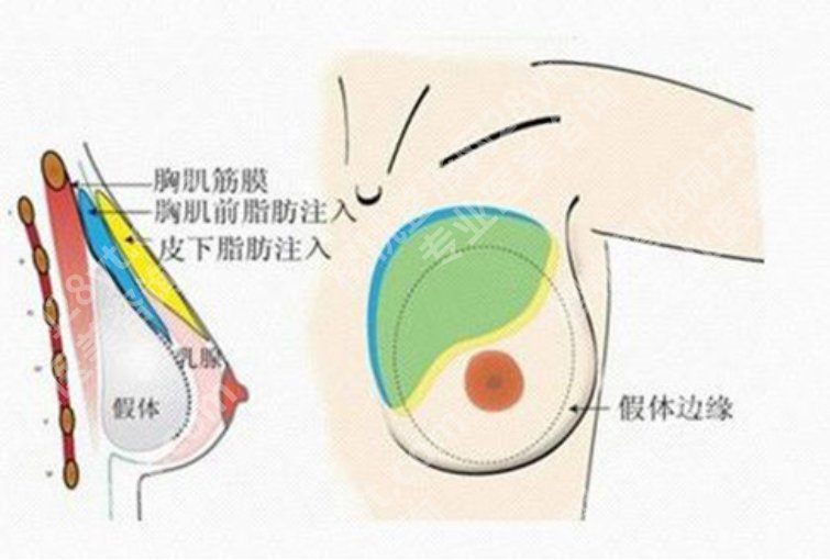 杨浦区中心医院隆胸怎么样？隆胸后假体会不会移位？