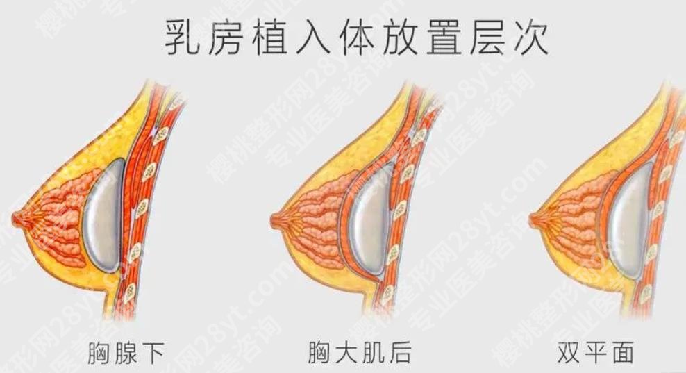 杨浦区中心医院隆胸怎么样？隆胸后假体会不会移位？