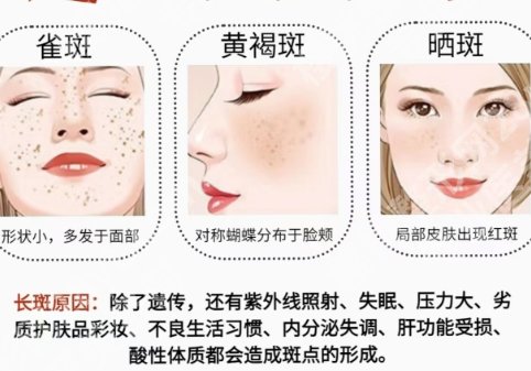 上海第八人民医院激光美容科怎么样？激光祛斑案例展示！