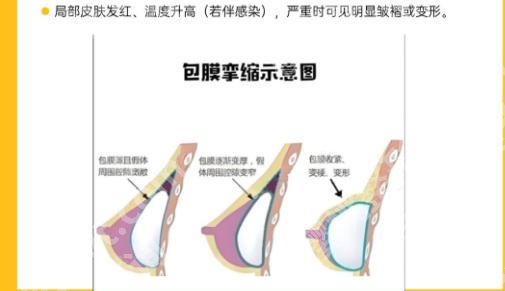 东莞人民医院隆胸好吗？优质医院推荐！快来看