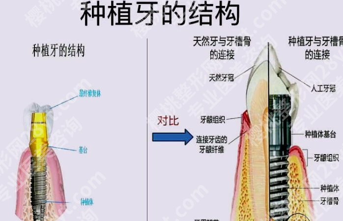 深圳人民医院种牙技术如何？张国权、周捷宇技术口碑好！