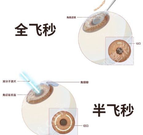 北京大学深圳医院近视激光手术费用贵不贵？准分子激光1w5左右起