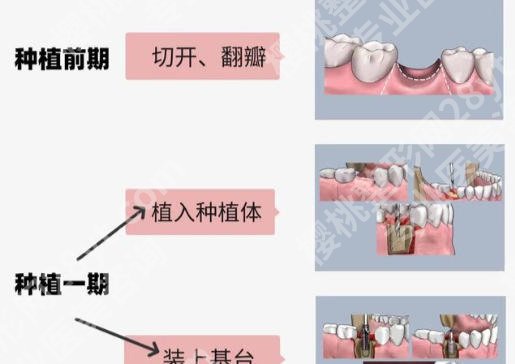 萧山人民医院牙齿种植怎么样？医生信息更新啦！