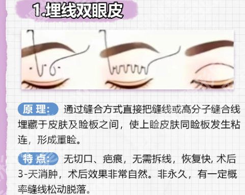 萧山第一人民医院做双眼皮手术好吗？本地公立医美实地体验分享