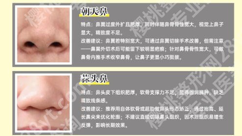 上海第六人民医院假体隆鼻怎么样？2026年价格大公开、看完再决定！