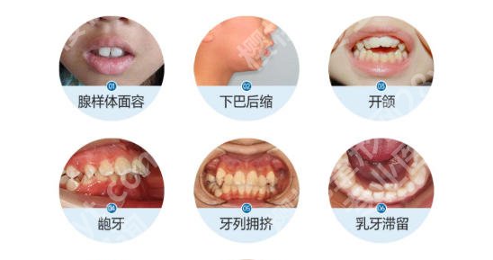 北医三院牙齿正畸费用表更新！