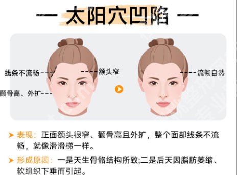 北京大学人民医院磨骨手术怎么样？技术价格揭秘、术前避坑必看！