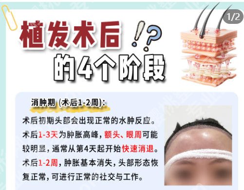中山大学附属第一医院植发哪个科室？看完这篇就懂了！