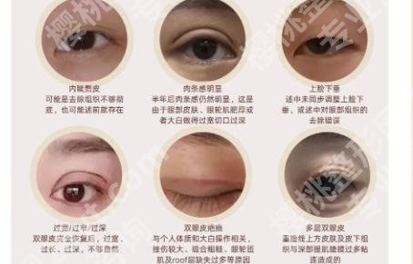 朝阳医院做双眼皮怎么样？适合不同眼部基础的医生推荐