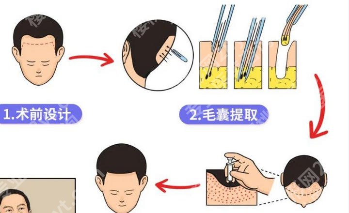 香港大学深圳医院植发中心靠谱吗？看完这份真实就诊反馈再做决定少踩坑