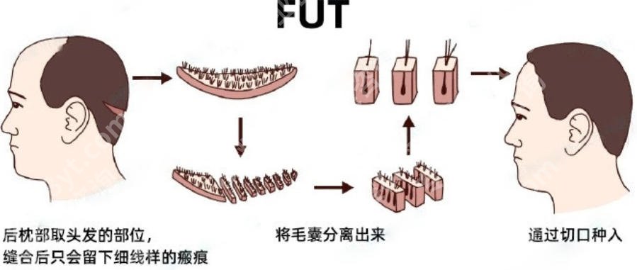 北京304医院植发和大麦对比哪个好？2026植发案例展示！