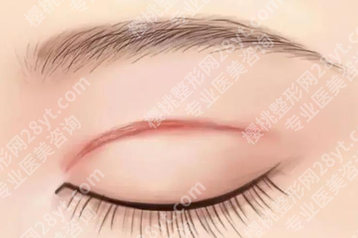 无锡二院割双眼皮怎么样？哪位医生做的比较自然？