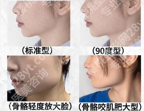 湖南省人民医院李波下颌角怎么样？擅长项目、案例风格和恢复期全解析