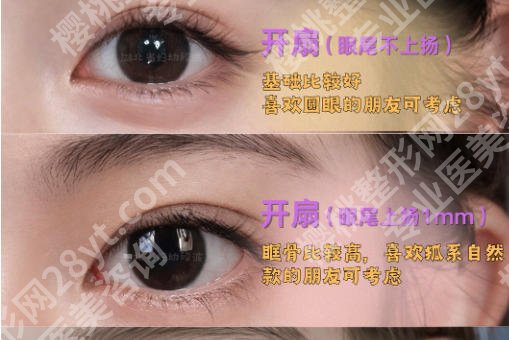 北京医院双眼皮手术多少钱一次？不同手术方式价格对照！