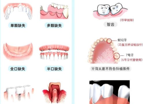 江门中心医院有种牙吗？术前检查和医生选择指南来啦！