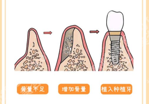 江门中心医院有种牙吗？术前检查和医生选择指南来啦！