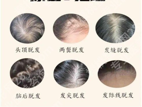 上海第九医院植发价格揭晓！手术方案费用详解！