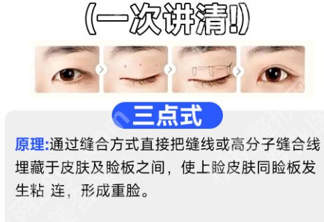 珠海人民医院割双眼皮价格揭晓！网友真实评价一览！