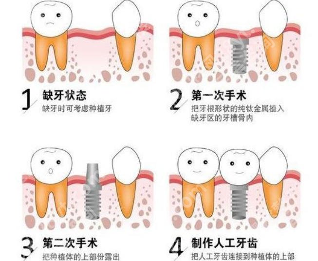 上海第八人民医院种植牙价格贵不贵？2026收费细节展示！
