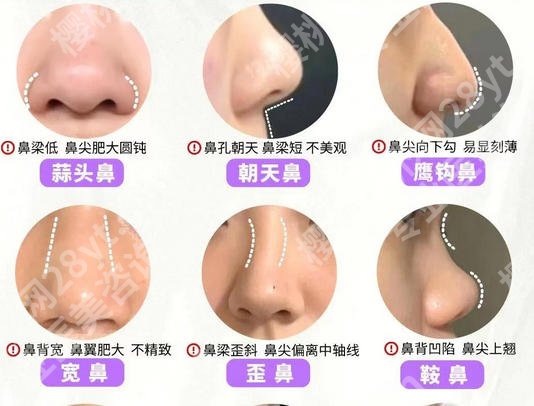 上海九院鼻修复专家排名榜单一览！祝联、钱云良、袁捷技术口碑好！