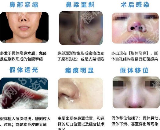 上海九院谁做鼻修复好？top榜前五名单揭晓！钱云良|王琛排名靠前！