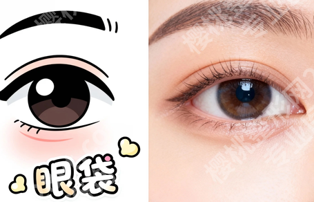 柳州哪里有做眼袋手术的|不用到处打听了,本地这些医院可以了解一下