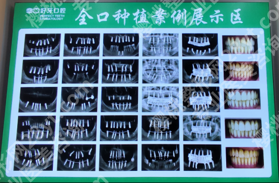 种植牙和镶牙怎么选？北京好牙口腔一文讲透修复原理不踩坑