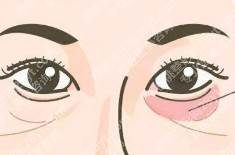 十堰哪家医院做眼袋好？不想顶着大眼袋显疲惫，先看看本地医院