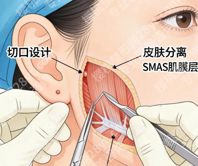 上海九院整形拉皮什么价？价目表解析！小拉皮3.6w左右起！