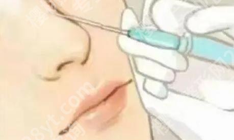 上海九院注射隆鼻多少钱？大概24,000~43,000元左右！