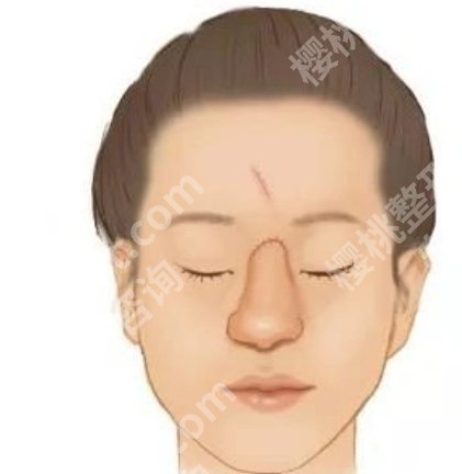 上海九院做鼻骨复位多少钱？大概12,000~38,000左右|真实评价来袭
