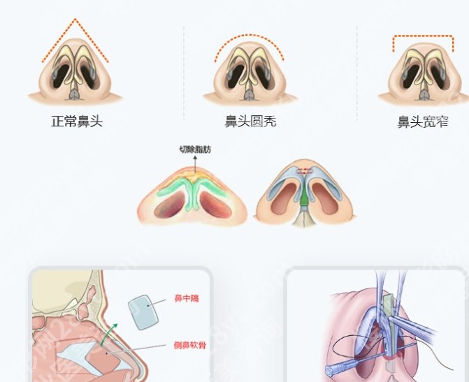 上海九院做鼻骨复位多少钱？大概12,000~38,000左右|真实评价来袭