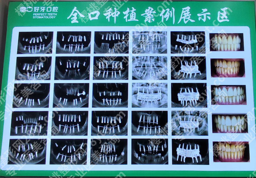 北京种牙选好牙口腔:私人牙医一对一,种牙诊疗加术后维护全包